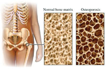 OSTEOPOROSIS