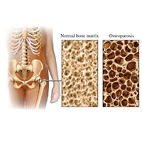 OSTEOPOROSIS