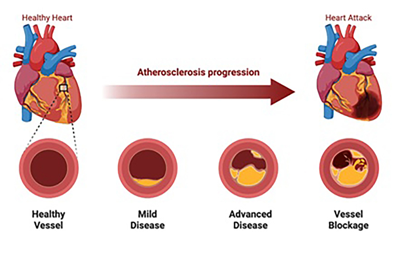 Atherosclerosis progression