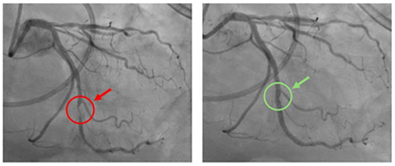Heart disease symptom